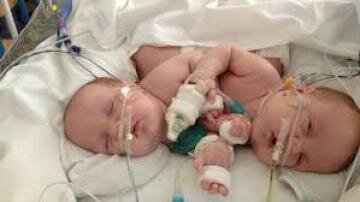 Conjoined Twins Are Successfully Separated in Dallas Conjoined Twins Are Successfully Separated in Dallas